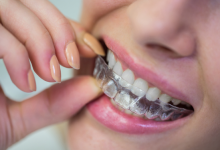 5 Retainer and Clear Aligner Matters to Pay Attention To