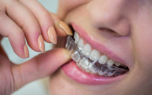 5 Retainer and Clear Aligner Matters to Pay Attention To